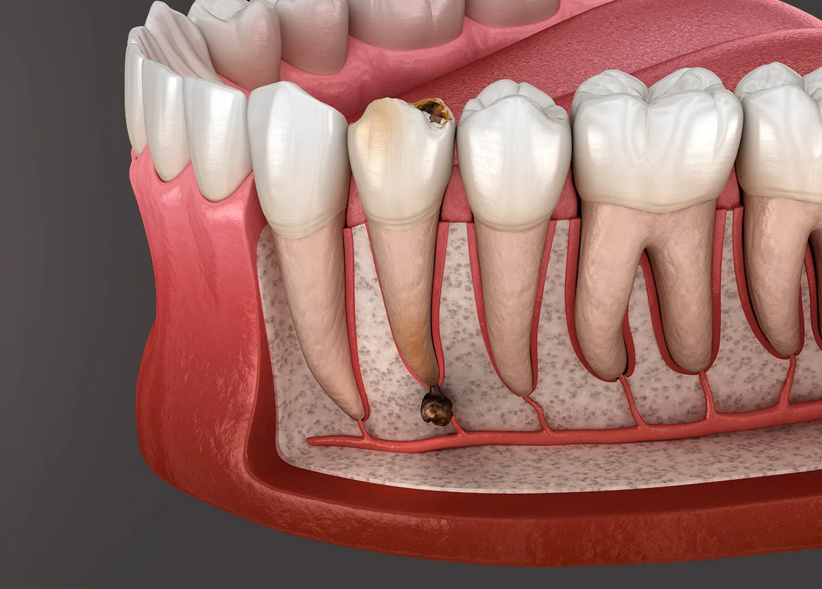How to Ease Jaw Pain After Tooth Removal